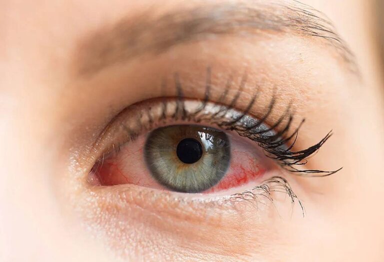efectos de la primavera salud ocular