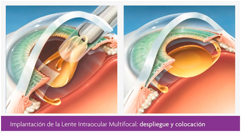 tratamiento-cataratas-implantacion-lente